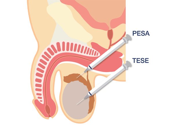 Azoospermia Treatment