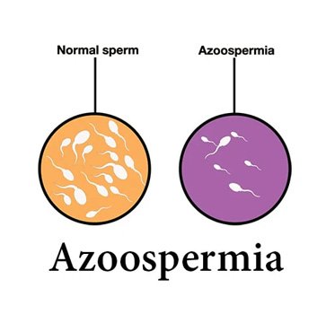 Azoospermia