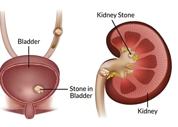 Open Prostate Surgery