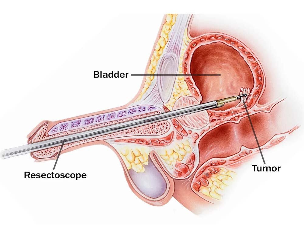 Bladder Tumor Surgery