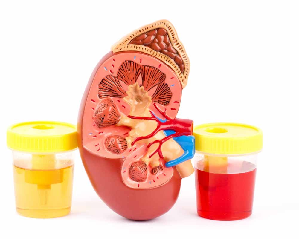 Blood in Urine Treatment