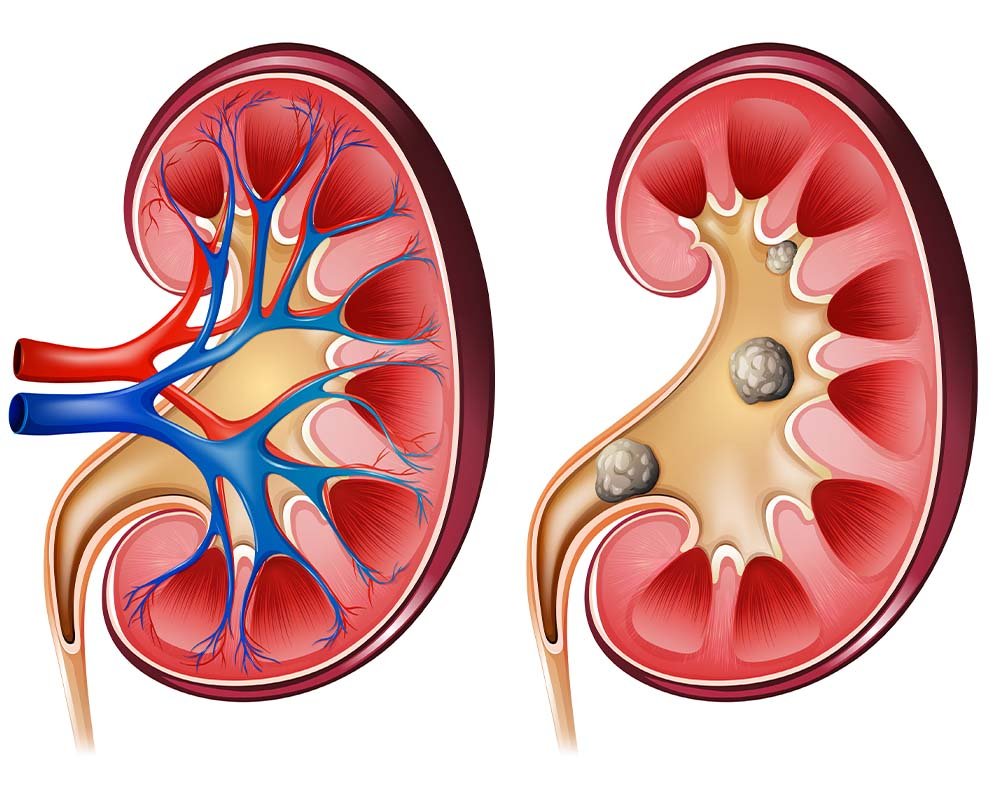 Kidney Stone Treatment