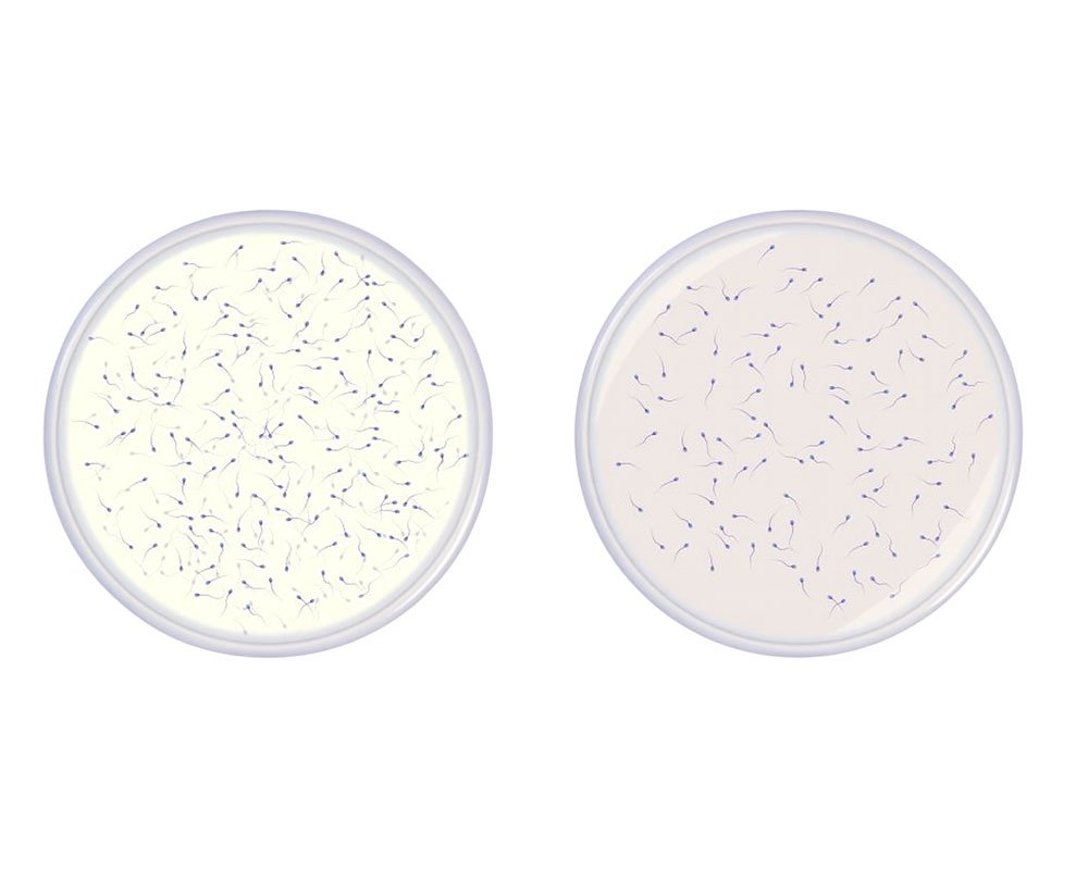 Male Infertility Treatment