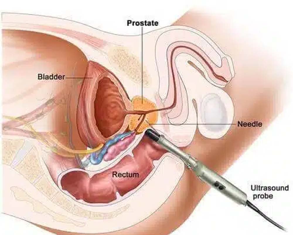 Open Prostate Surgery