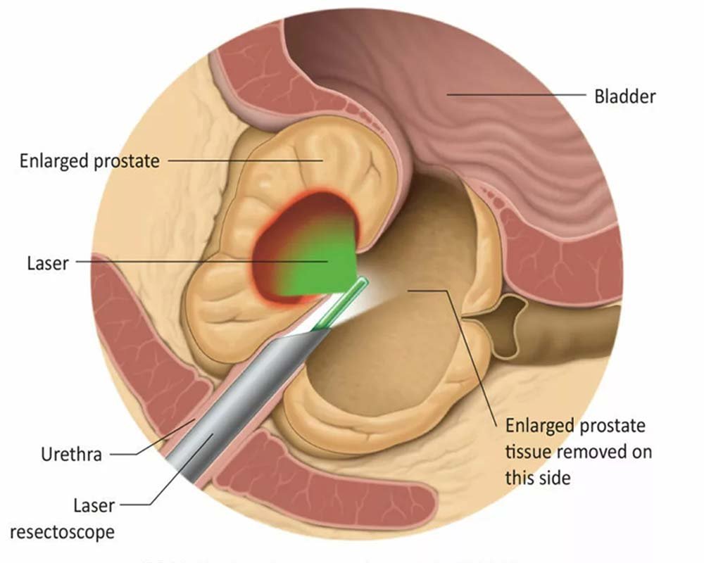 Prostate Laser Surgery