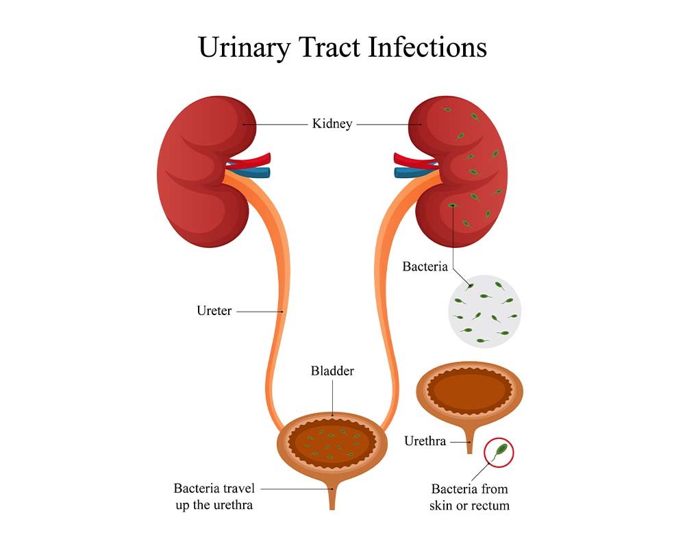 UTI Treatment