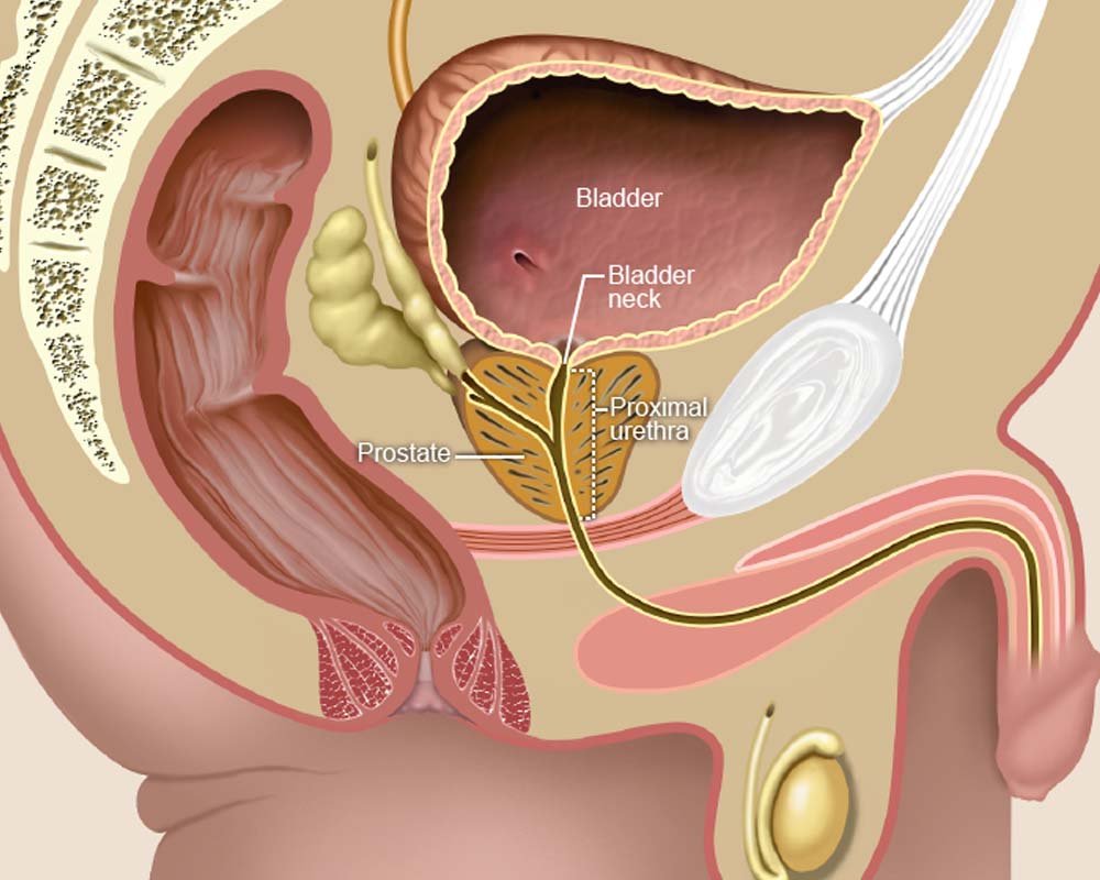 Urinary Tract Obstruction